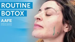 Routine Botox Treatment | AAFE