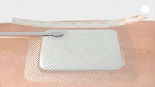 PICO Application over a skin graft