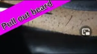 Extractions Ingrown Hair l Tweezers Beard l Full HD2020/11/22