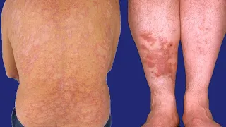 Diabetic Skin Conditions