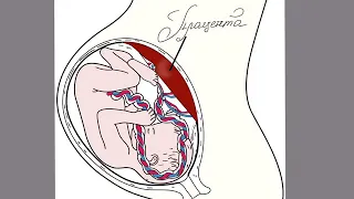 Плацента. Предлежание плаценты. Отслойка плаценты.