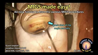 CataractCoach 1185: MIGS made easy - Minimally Invasive Glaucoma Surgery