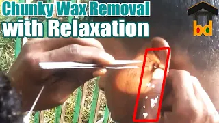 ►Impacted Huge Chunky White Wax Removal ASMR BD II Super Fresh Ear Cleaning by Young Guys