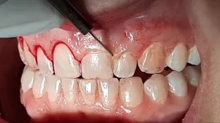 Treating Excessive Gingival Display with Crown Lengthening - Dr. Hussam Hassan