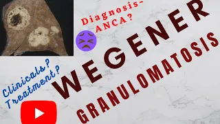 WEGENER granulomatosis|What causes Wegener's granulomatosis?Is Wegener's curable?usmle,neetpg,plab