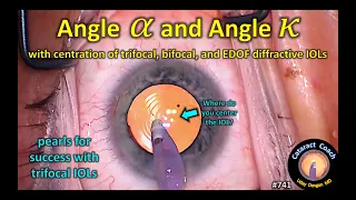 understanding Angle Alpha and Angle Kappa with trifocal and mutlifocal IOLs