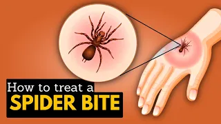 How to Treat A Spider's Bite?