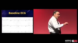 ECG Mini Master-Class: Subtle ACS