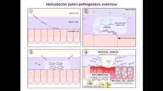 Helicobacter pylori infection and diseases