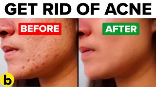 13 Home Remedies To Get Rid Of Acne Naturally