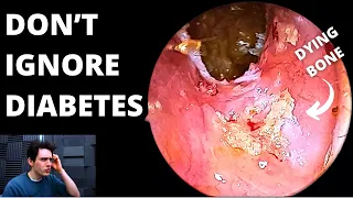 Don't Ignore Diabetes (Complications During Earwax Removal)