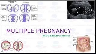 Multiple Pregnancy, Important Points from RCOG and NICE Guidelines