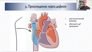 Хирургические нюансы имплантации окклюдера ДМПП