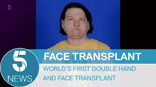World’s first successful double hand and face transplant | 5 News