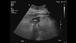 Masculino de 33 años, con dolor en fosa ilíaca derecha de 2 días de evolución.