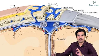 Epidural Hematoma (Epidural hemorrhage): Etiology, Clinical features, Diagnosis and Treatment