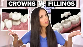 Dental Crowns Vs Dental Fillings (What's the Difference?)