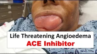 Life Threatening ACE Inhibitor Induced Angioedema