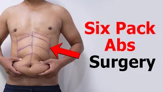 Six Pack Abs surgery | Six Pack Abs surgery Result | Liposuction cost | Liposuction result