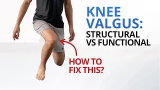 Why You Need to Fix Dynamic Knee Valgus NOW