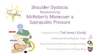 Shoulder Dystocia : Resolution byMcRoberts Maneuver & Suprapubic Pressure | O&G CUHK