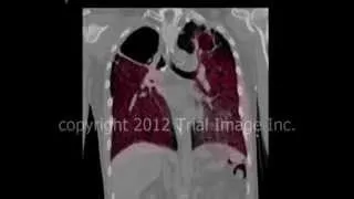 Tuberculosis  and lung cavitation video - Animation by Cal Shipley, M.D.
