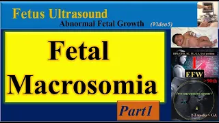 Fetus Ultrasound, Fetal Macrosomia- Part1