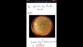 Case 10: Central Serous Chorio Retinopathy (CSCR) - A complete review