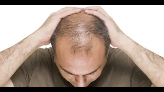 Sinta-se Bem - Você sabe o que é Alopecia?