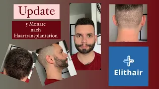 Update: 5 Monate nach Haartransplantation bei Elithair