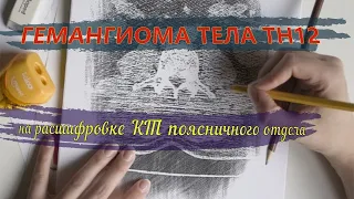 ГЕМАНГИОМА тела th12 позвонка и КОМПРЕССИОННЫЙ ПЕРЕЛОМ позвоночника на РАСШИФРОВКЕ КТ второе мнение