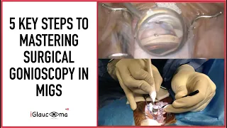 5 Key Steps to Mastering Surgical Gonioscopy in MIGS