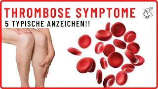 ❗THROMBOSE SCHNELL ERKENNEN❗ Diese 5 Thrombose Anzeichen/Symptome solltest du unbedingt kennen!!!