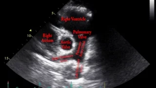 Echocardiogram Parasternal Short Axis View Pulmonary Arteries - Loop