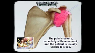 Adhesive Capsulitis Frozen Shoulder - Everything You Need To Know - Dr. Nabil Ebraheim