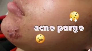 Skin Purging | Does Acne Have to Get Worse Before It Gets Better?