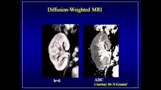 Renal Transplantation imaging Prof  Tarek El Diasty