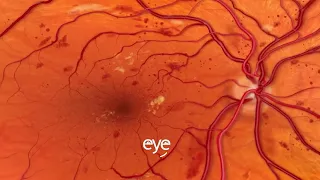 Diabetic Retinopathy neovascularization, patient education video animation.