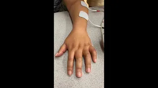 Electrical Stimulation for Stroke Survivors: Fingers