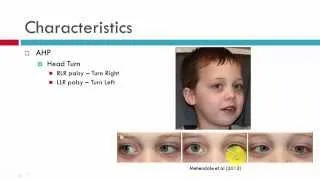 VIth CN Palsy Characteristics