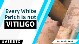 Every White Patch in Skin Is Vitiligo? Dr. Rohit Goel