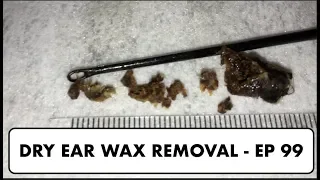 DRY EAR WAX REMOVAL - EP 99