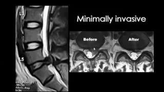 Spinal imaging Postoperative spine   DRE 5   Dr Mamdouh Mahfouz 720p