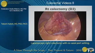 Laparoscopic right colectomy with co-axial port setting