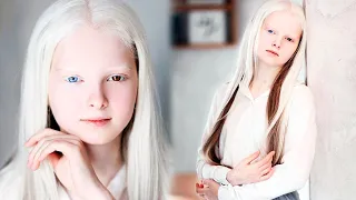 Чеченская девочка - альбинос с гетерохромией. Амина Эпендиева.