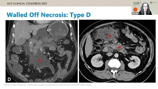 Contemporary Management of Acute Infected Necrotizing Pancreatitis  | Imaging  |  Surgical Treatment