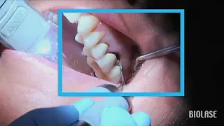 Remoción de caries con lasers Biolase | Streamhealth Dental