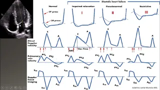 diastolic dysfunction part II-grading ASE 2016