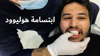 تجربتي الكاملة مع ابتسامة هوليوود  للاسنان 🦷