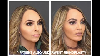 Before You Get a Chin Implant, Watch This